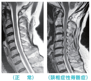 頚椎 症 性 神経 根 症 と は