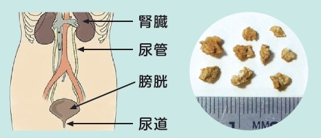 和らげる 結石 尿 管 痛み 尿管結石の痛み緩和方法｜お風呂で温かい湯舟につかるのが最も効果的｜グリーンマン８