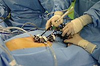 既存の手術器具を利用した腹腔鏡下胆嚢摘出術