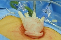 医療用手袋を利用した腹腔鏡下虫垂切除術（グローブ法）