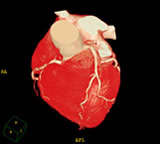 西陣病院、心臓の３次元ＣＴ