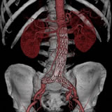 西陣病院、大動脈とステント