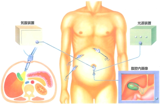 腹腔鏡下胆嚢摘出術