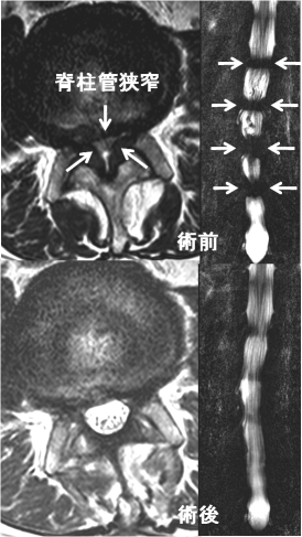 腰部脊柱管狭窄症術前、術後MRI