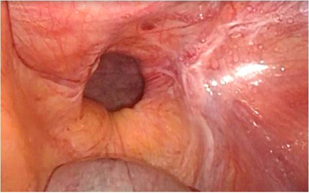 腹腔鏡下鼠径ヘルニア修復術について_図1