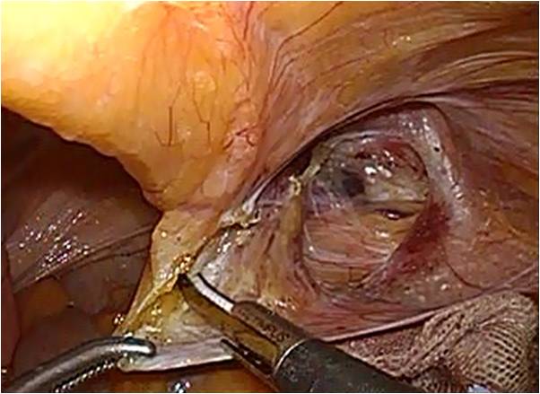 腹腔鏡下鼠径ヘルニア修復術について_図3