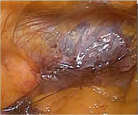 腹腔鏡下鼠径ヘルニア修復術について_図5