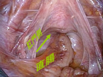直腸脱について_図2