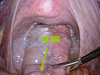 直腸脱について_図3