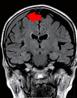 認知症とMRI_図2