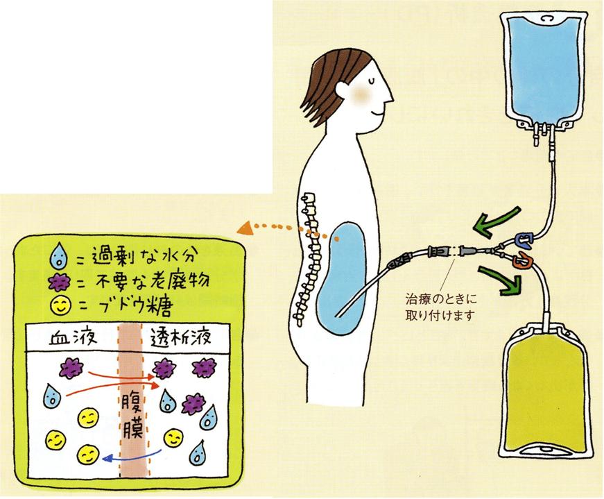 と は 洗浄 膀胱 膀胱洗浄とは～看護技術：手技と手順の説明～