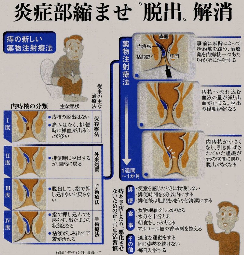 いぼ痔は切らずに治したい いぼ痔の注射療法 西陣病院だより