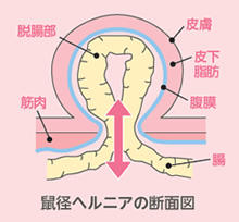 鼠径ヘルニア断面図