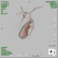 3D-DIC-CTで胆嚢が描出されれば、単孔式腹腔鏡下胆嚢摘出術が可能