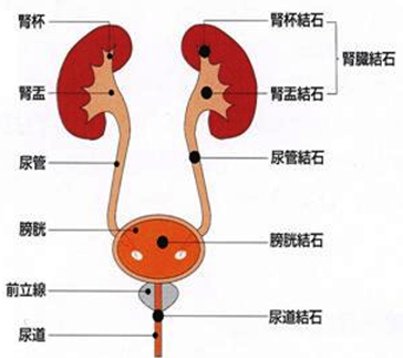 尿路結石