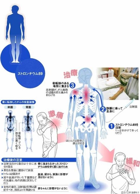 症状 骨 転移