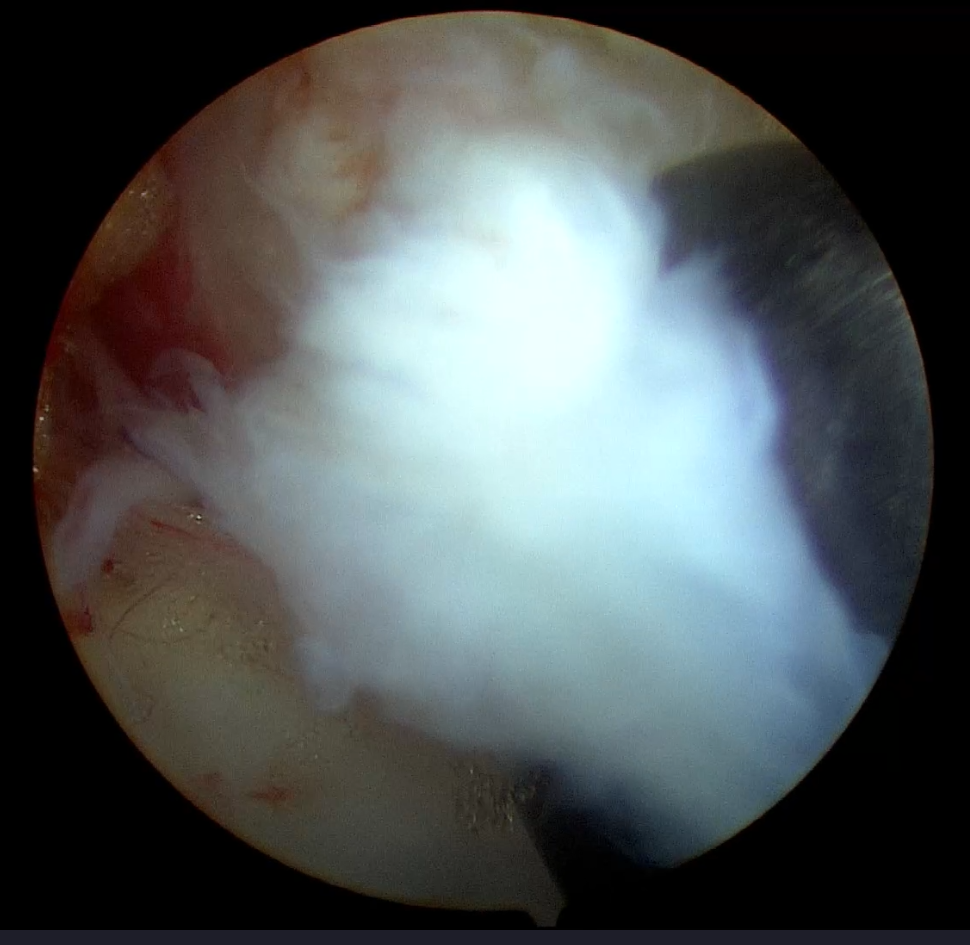 （３）腰椎椎間板ヘルニア摘出中②