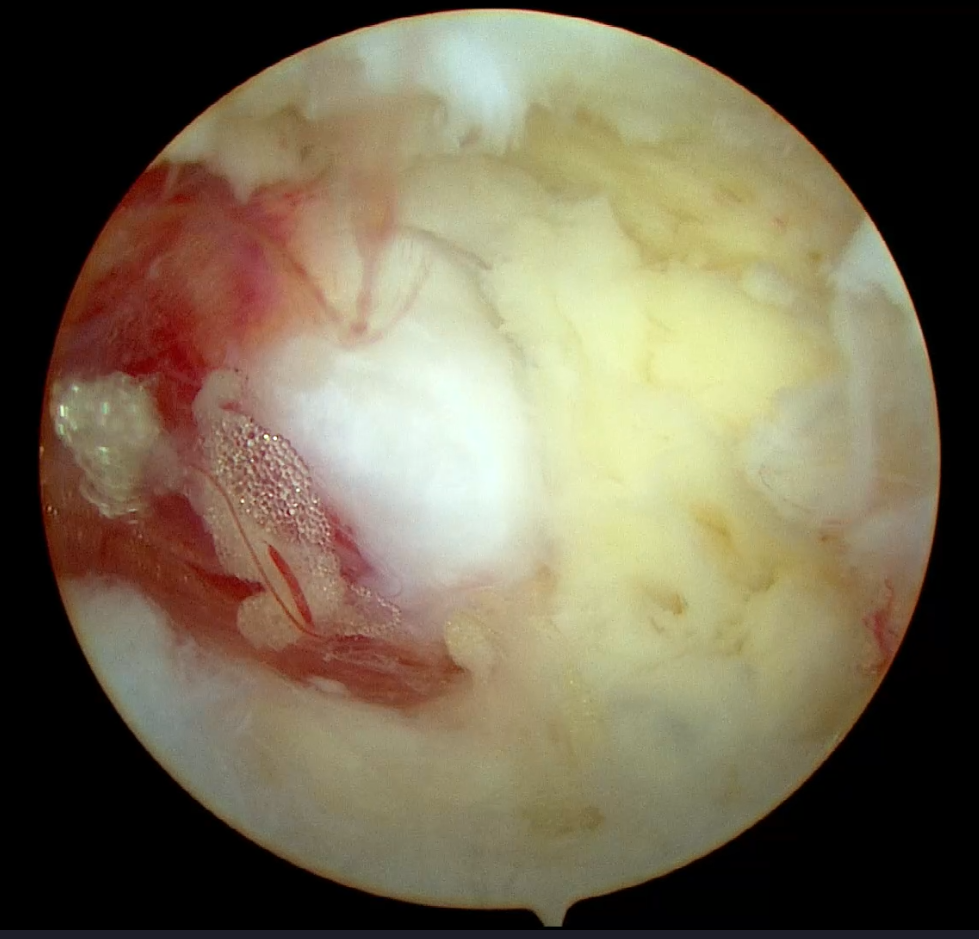 （１）腰椎椎間板ヘルニア