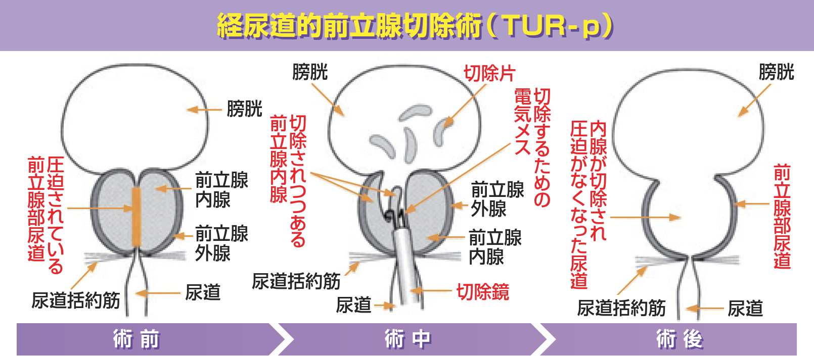 予防 前立腺 肥大