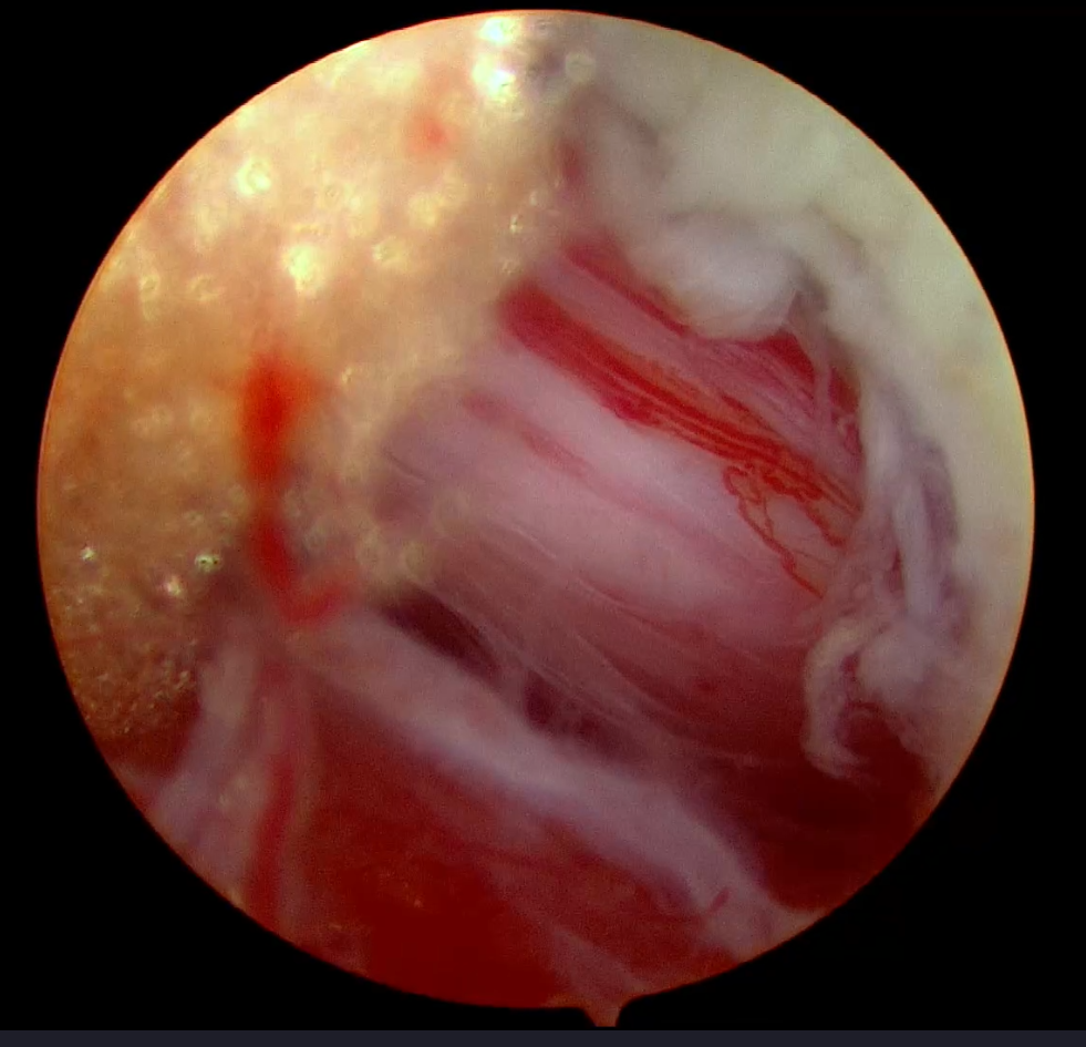 （４）腰椎椎間板ヘルニア摘出後
