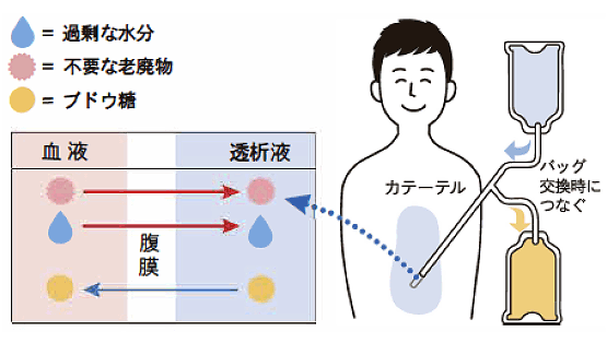 腹膜透析外来